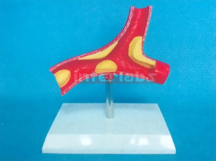 DESK TYPE DISEASE ARTERY MODEL WITH DESCRIPTION PLATE